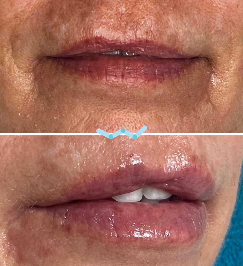 Botulinumtoxin - Imagebild