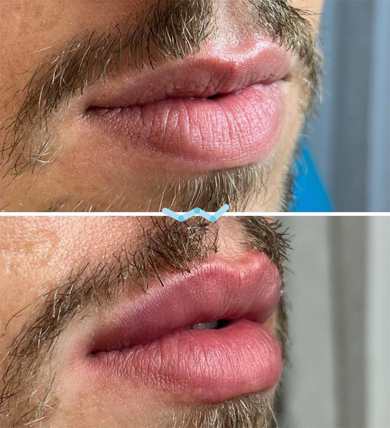 Botulinumtoxin - Imagebild
