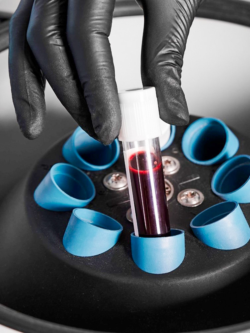 PRP - Therapie