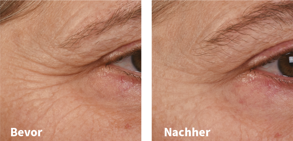 Vorher-Nachher-Vergleich
